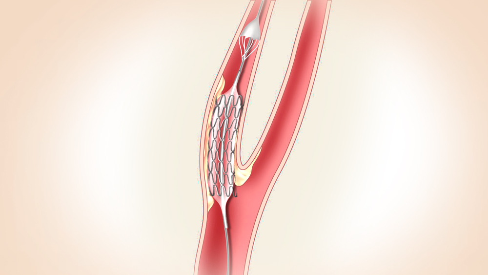 Karotis Artere Stent Yerleştirme İşlemi